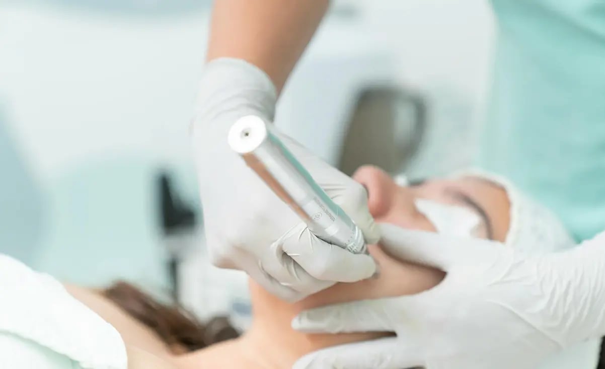 Microdermabrasion Treatment